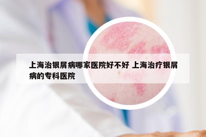 上海治银屑病哪家医院好不好 上海治疗银屑病的专科医院