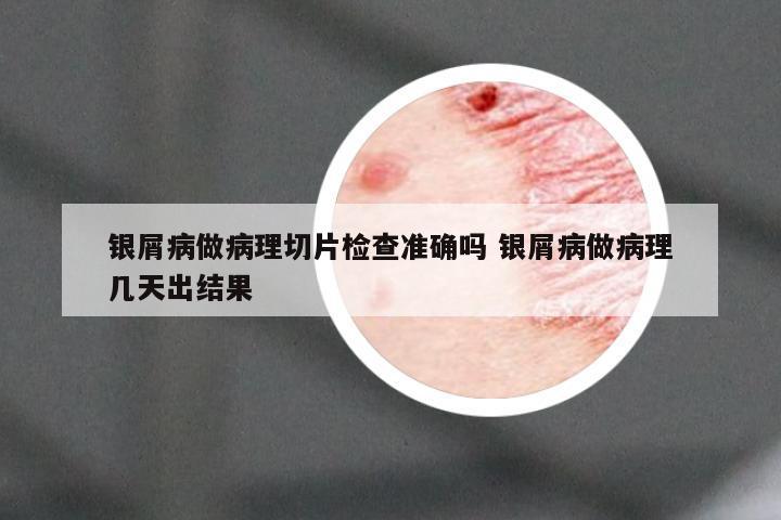银屑病做病理切片检查准确吗 银屑病做病理几天出结果