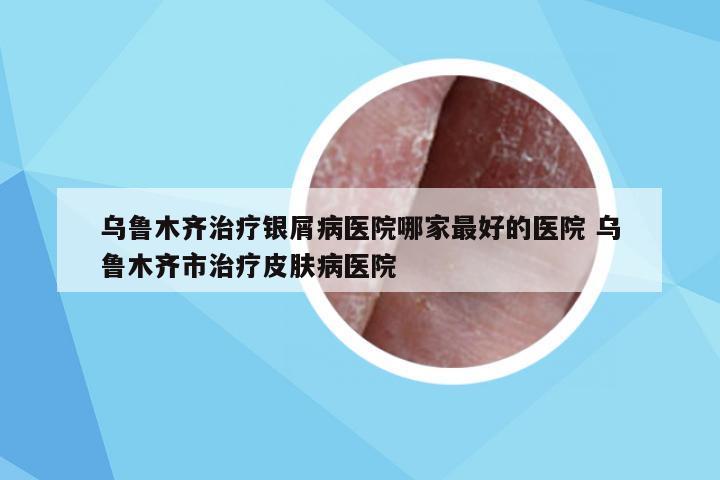 乌鲁木齐治疗银屑病医院哪家最好的医院 乌鲁木齐市治疗皮肤病医院