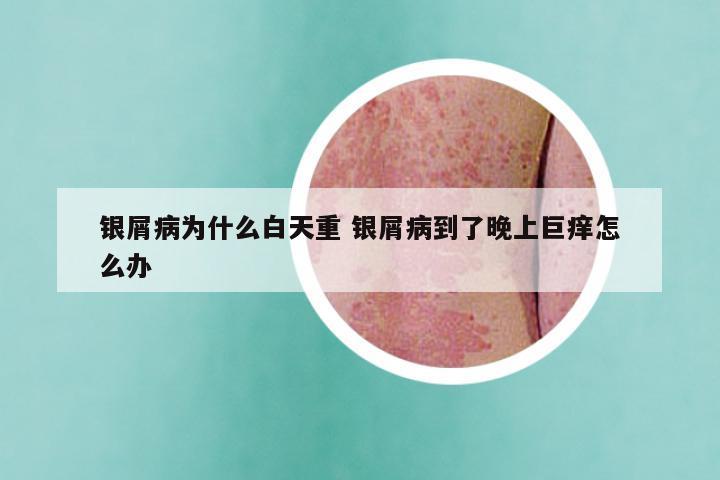 银屑病为什么白天重 银屑病到了晚上巨痒怎么办