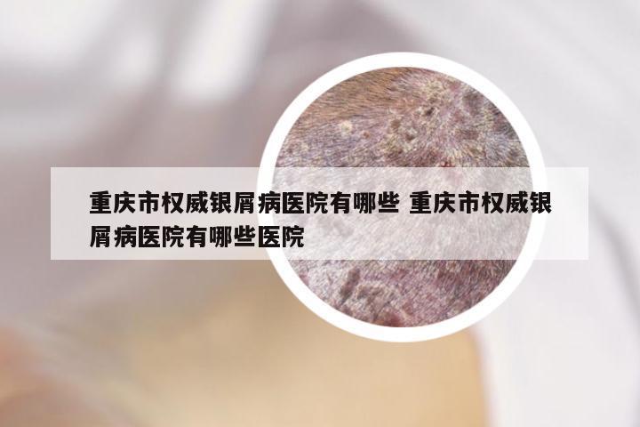 重庆市权威银屑病医院有哪些 重庆市权威银屑病医院有哪些医院