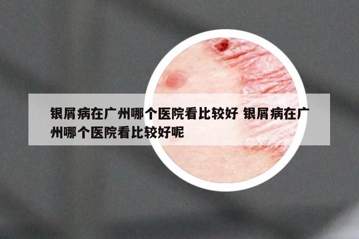 银屑病在广州哪个医院看比较好 银屑病在广州哪个医院看比较好呢