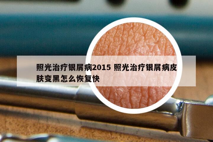照光治疗银屑病2015 照光治疗银屑病皮肤变黑怎么恢复快