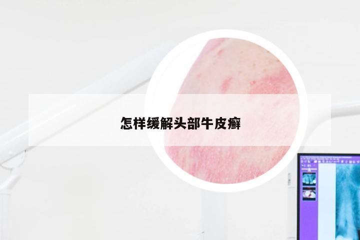 怎样缓解头部牛皮癣