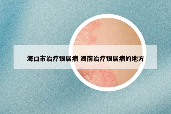 海口市治疗银屑病 海南治疗银屑病的地方