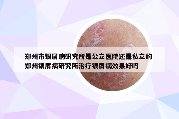 郑州市银屑病研究所是公立医院还是私立的 郑州银屑病研究所治疗银屑病效果好吗