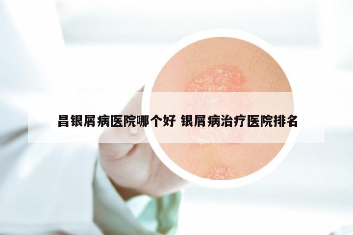 昌银屑病医院哪个好 银屑病治疗医院排名
