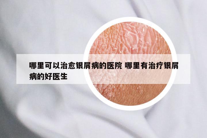 哪里可以治愈银屑病的医院 哪里有治疗银屑病的好医生