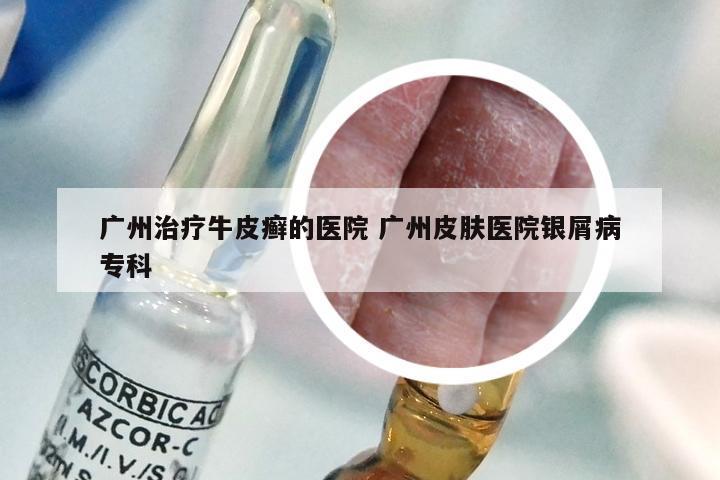 广州治疗牛皮癣的医院 广州皮肤医院银屑病专科