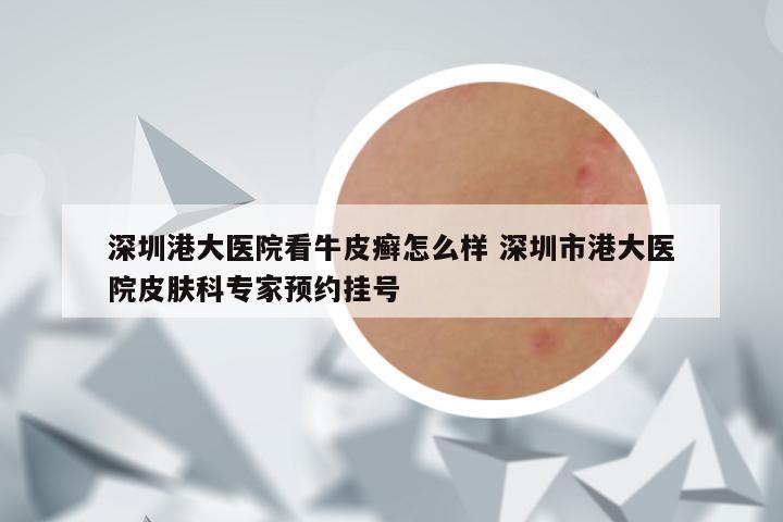 深圳港大医院看牛皮癣怎么样 深圳市港大医院皮肤科专家预约挂号