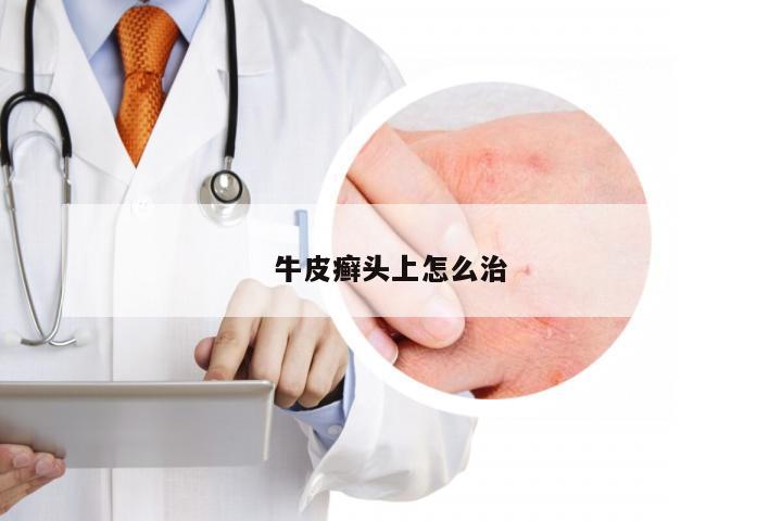 牛皮癣头上怎么治
