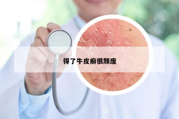 得了牛皮癣很颓废