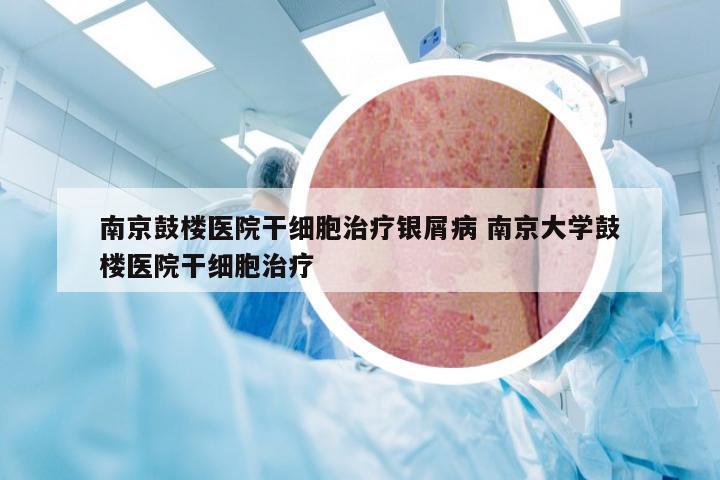 南京鼓楼医院干细胞治疗银屑病 南京大学鼓楼医院干细胞治疗
