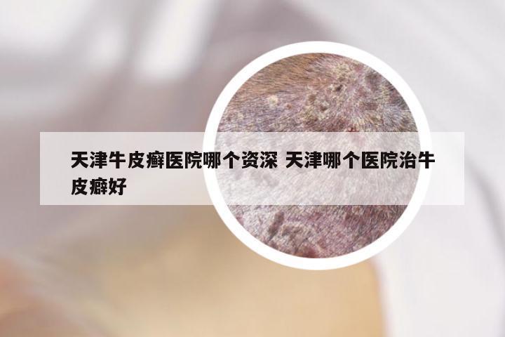 天津牛皮癣医院哪个资深 天津哪个医院治牛皮癖好