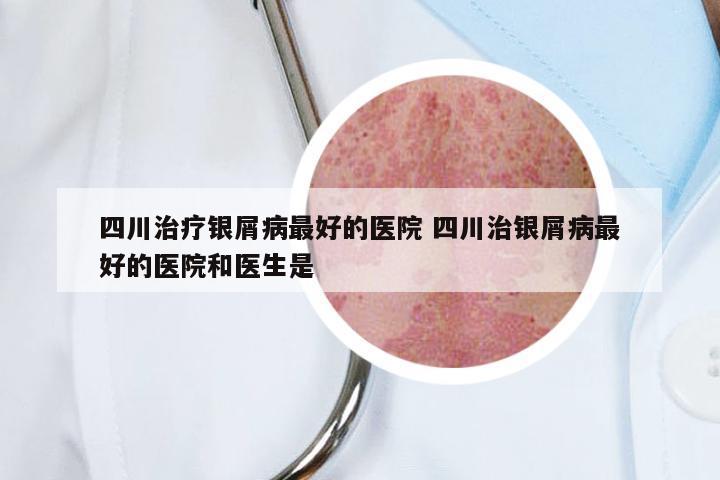 四川治疗银屑病最好的医院 四川治银屑病最好的医院和医生是