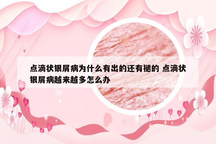 点滴状银屑病为什么有出的还有褪的 点滴状银屑病越来越多怎么办