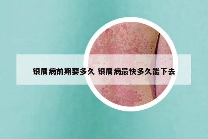 银屑病前期要多久 银屑病最快多久能下去