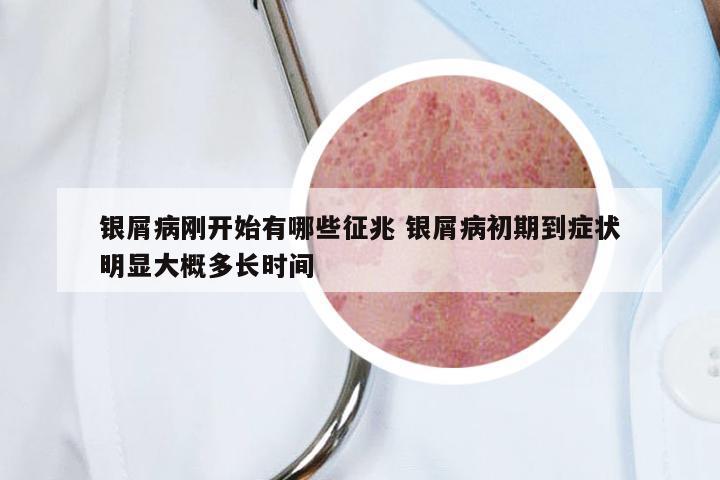 银屑病刚开始有哪些征兆 银屑病初期到症状明显大概多长时间