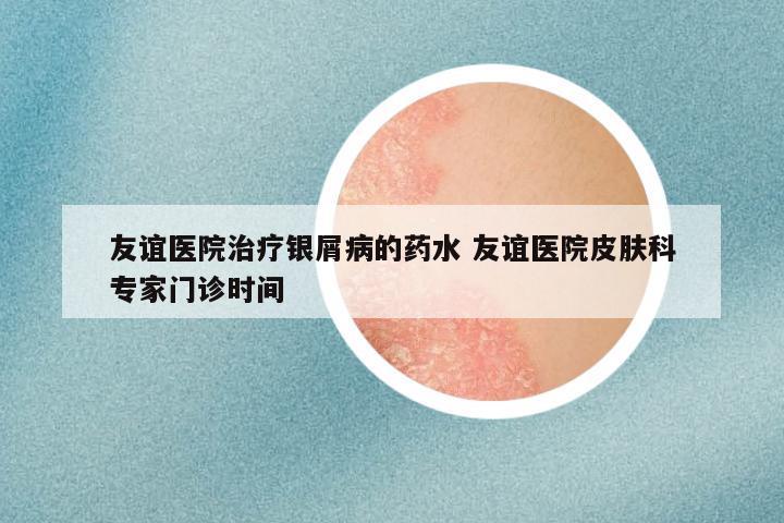 友谊医院治疗银屑病的药水 友谊医院皮肤科专家门诊时间