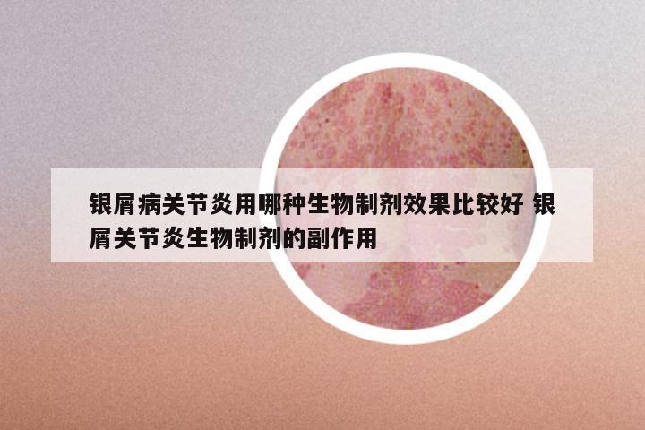银屑病关节炎用哪种生物制剂效果比较好 银屑关节炎生物制剂的副作用