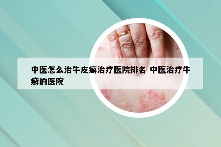 中医怎么治牛皮癣治疗医院排名 中医治疗牛癣的医院