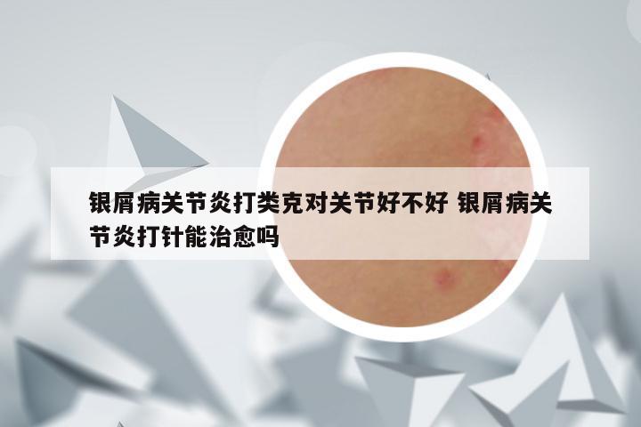 银屑病关节炎打类克对关节好不好 银屑病关节炎打针能治愈吗