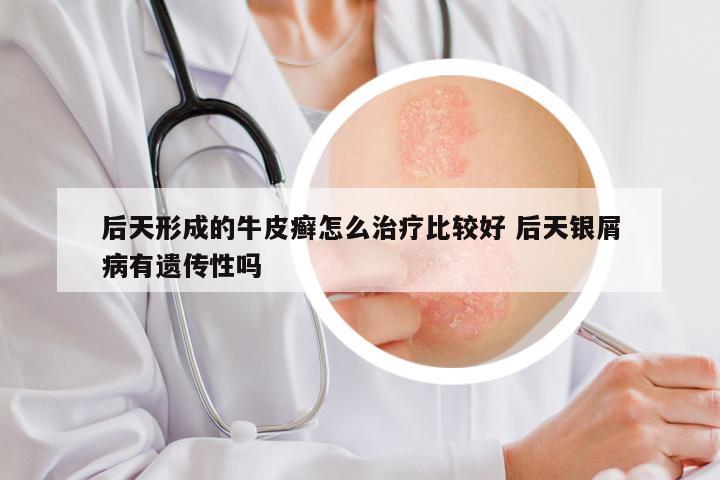 后天形成的牛皮癣怎么治疗比较好 后天银屑病有遗传性吗