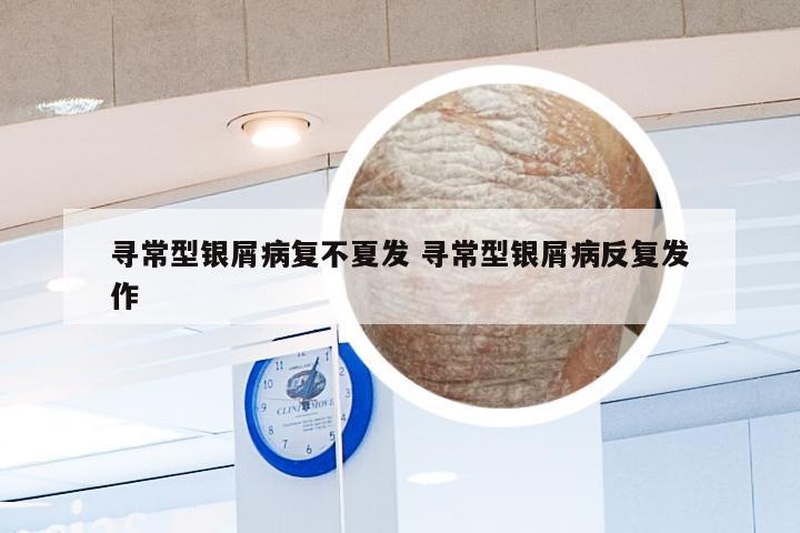 寻常型银屑病复不夏发 寻常型银屑病反复发作