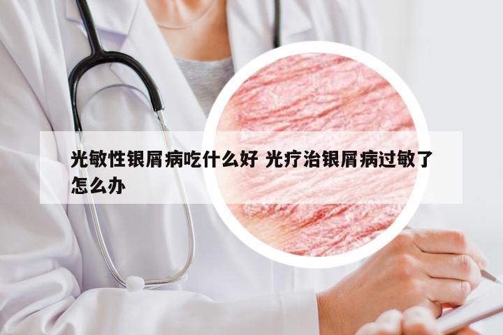 光敏性银屑病吃什么好 光疗治银屑病过敏了怎么办