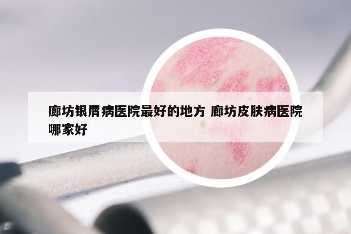 廊坊银屑病医院最好的地方 廊坊皮肤病医院哪家好
