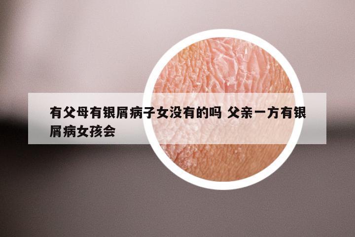 有父母有银屑病子女没有的吗 父亲一方有银屑病女孩会