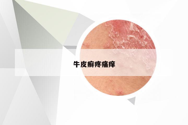 牛皮癣疼痛痒