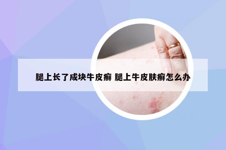 腿上长了成块牛皮癣 腿上牛皮肤癣怎么办