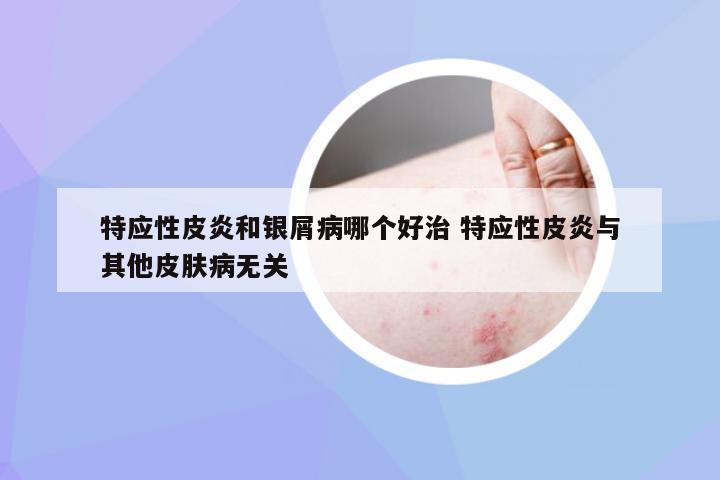 特应性皮炎和银屑病哪个好治 特应性皮炎与其他皮肤病无关