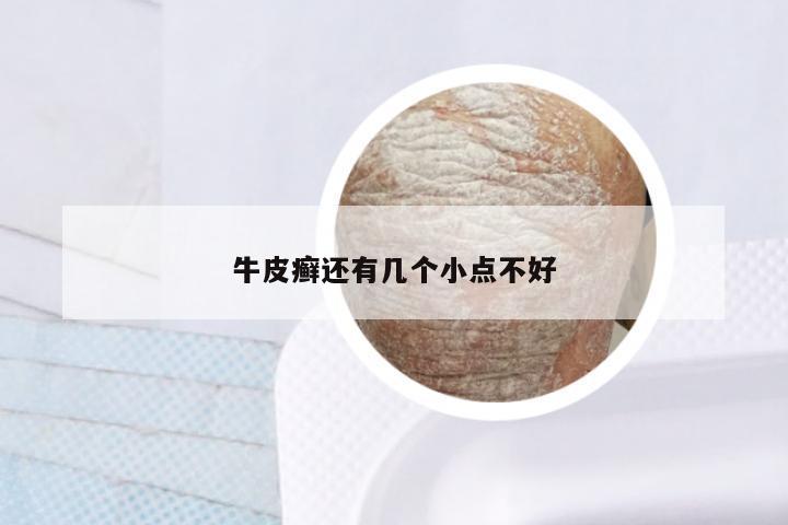 牛皮癣还有几个小点不好