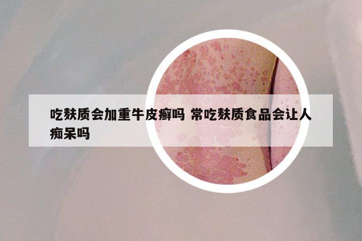 吃麸质会加重牛皮癣吗 常吃麸质食品会让人痴呆吗