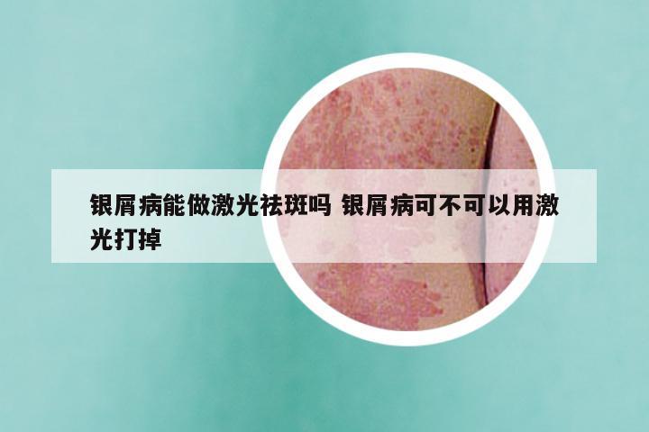 银屑病能做激光祛斑吗 银屑病可不可以用激光打掉
