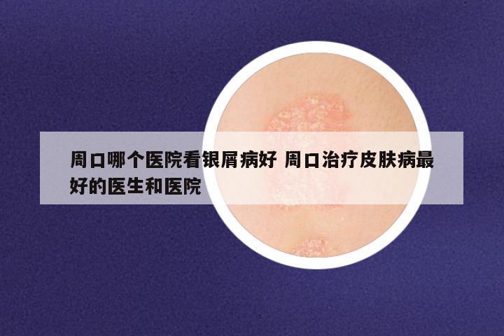 周口哪个医院看银屑病好 周口治疗皮肤病最好的医生和医院