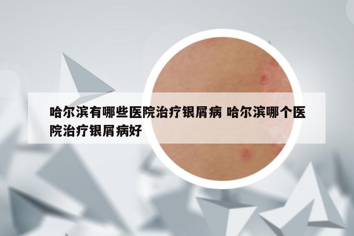 哈尔滨有哪些医院治疗银屑病 哈尔滨哪个医院治疗银屑病好