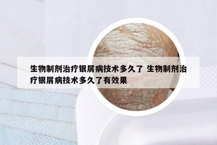 生物制剂治疗银屑病技术多久了 生物制剂治疗银屑病技术多久了有效果