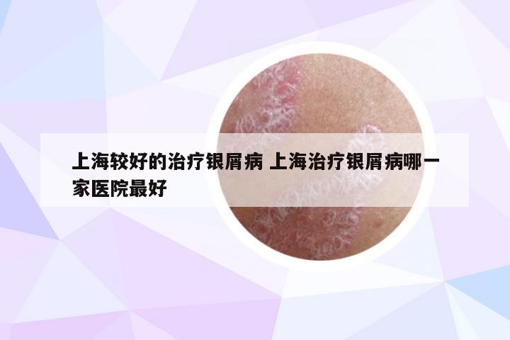 上海较好的治疗银屑病 上海治疗银屑病哪一家医院最好