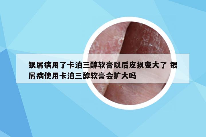 银屑病用了卡泊三醇软膏以后皮损变大了 银屑病使用卡泊三醇软膏会扩大吗
