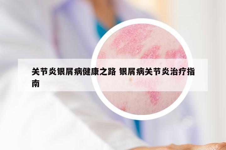 关节炎银屑病健康之路 银屑病关节炎治疗指南