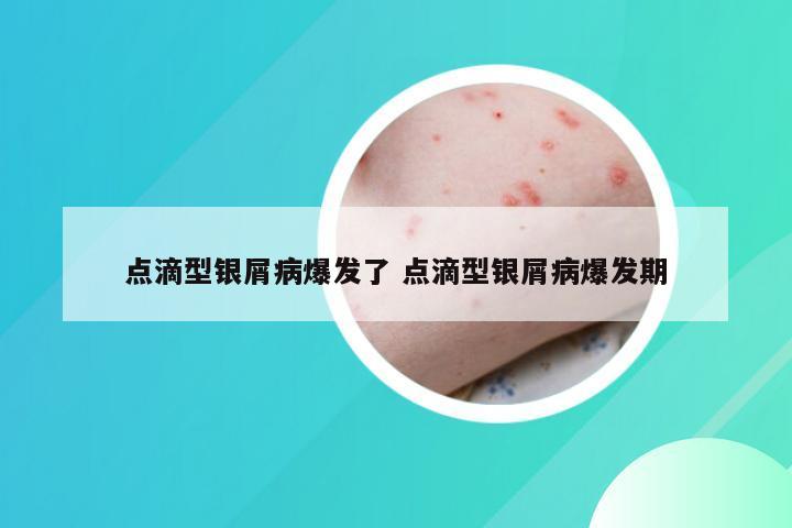 点滴型银屑病爆发了 点滴型银屑病爆发期