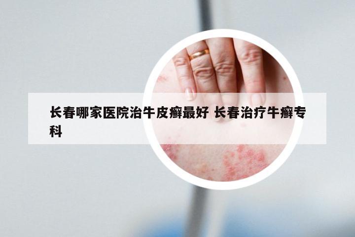 长春哪家医院治牛皮癣最好 长春治疗牛癣专科
