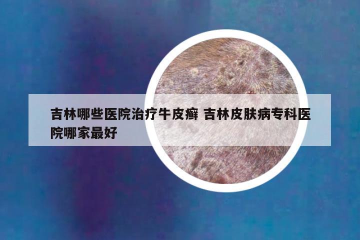 吉林哪些医院治疗牛皮癣 吉林皮肤病专科医院哪家最好