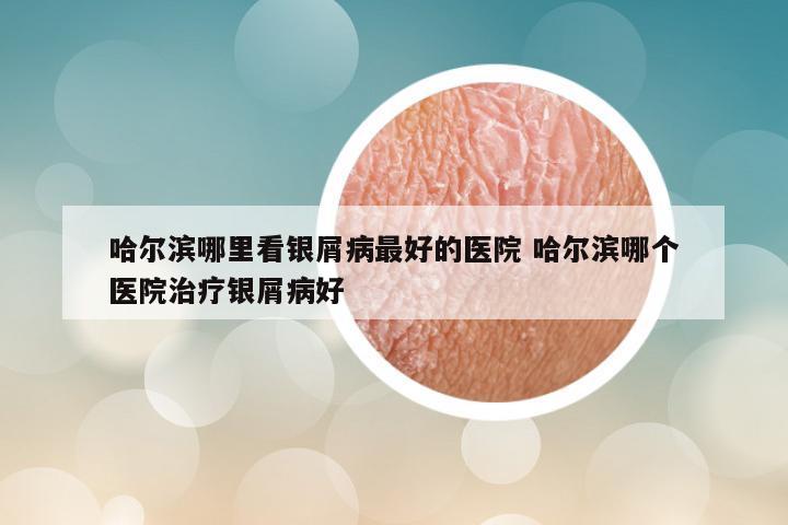 哈尔滨哪里看银屑病最好的医院 哈尔滨哪个医院治疗银屑病好