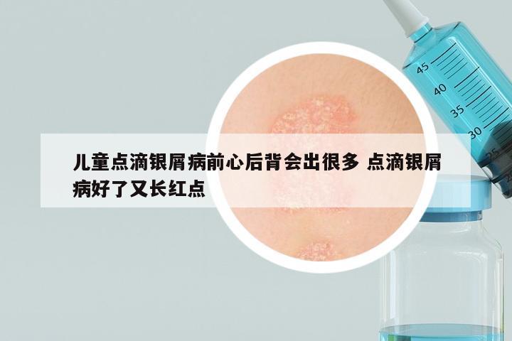 儿童点滴银屑病前心后背会出很多 点滴银屑病好了又长红点