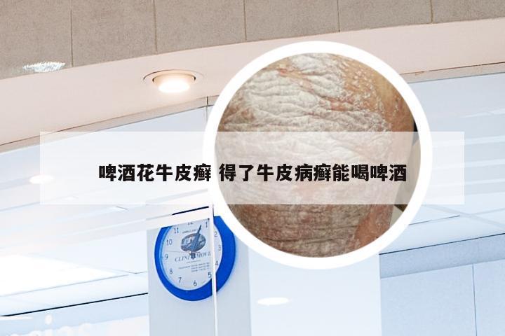 啤酒花牛皮癣 得了牛皮病癣能喝啤酒