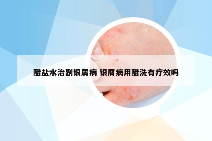 醋盐水治副银屑病 银屑病用醋洗有疗效吗